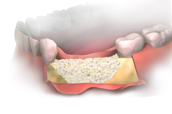Bone And Gum Grafting Before Dental Implant Placement