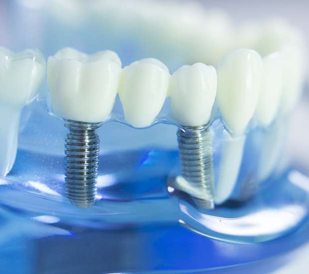 Venice Dental Implants