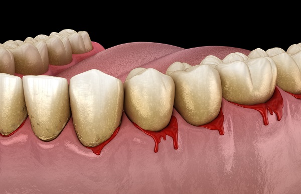 Common Signs Of Gum Disease