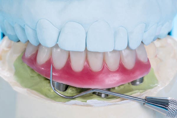 How Implant Supported Dentures Can Benefit Your Oral Health