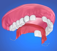 Venice Partial Denture for One Missing Tooth