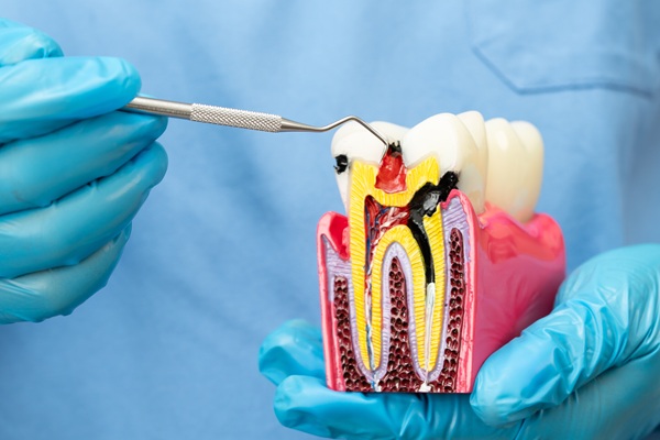 When To Consider A Root Canal Over A Tooth Extraction